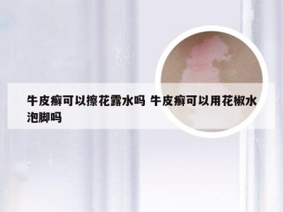 牛皮癣可以擦花露水吗 牛皮癣可以用花椒水泡脚吗