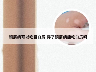 银屑病可以吃昆白瓜 得了银屑病能吃白瓜吗