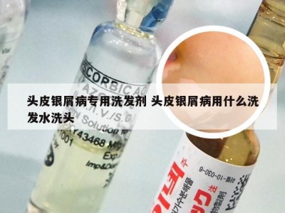 头皮银屑病专用洗发剂 头皮银屑病用什么洗发水洗头