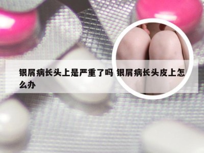银屑病长头上是严重了吗 银屑病长头皮上怎么办