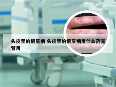 头皮里的银屑病 头皮里的银屑病用什么药膏管用