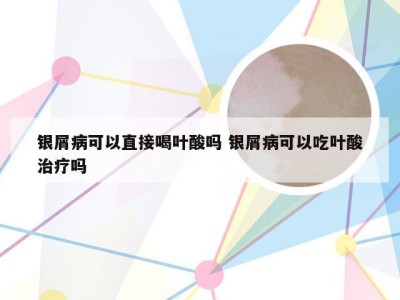 银屑病可以直接喝叶酸吗 银屑病可以吃叶酸治疗吗
