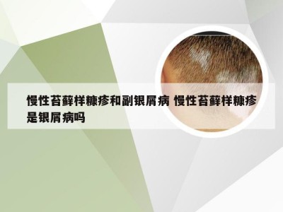 慢性苔藓样糠疹和副银屑病 慢性苔藓样糠疹是银屑病吗