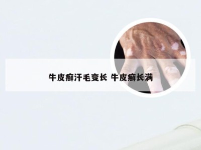 牛皮癣汗毛变长 牛皮癣长满