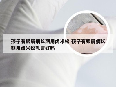 孩子有银屑病长期用卤米松 孩子有银屑病长期用卤米松乳膏好吗