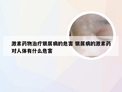 激素药物治疗银屑病的危害 银屑病的激素药对人体有什么危害