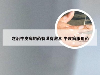 吃治牛皮癣的药有没有激素 牛皮癣服用药