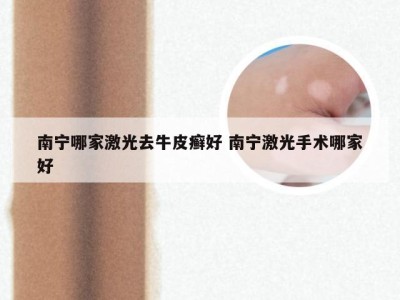 南宁哪家激光去牛皮癣好 南宁激光手术哪家好