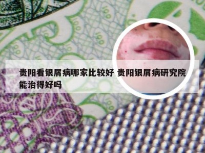 贵阳看银屑病哪家比较好 贵阳银屑病研究院能治得好吗