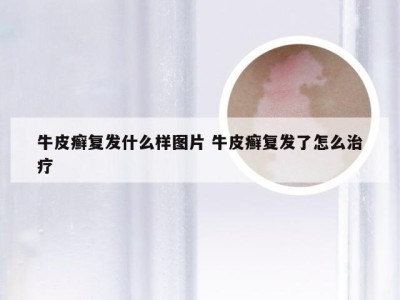 牛皮癣复发什么样图片 牛皮癣复发了怎么治疗