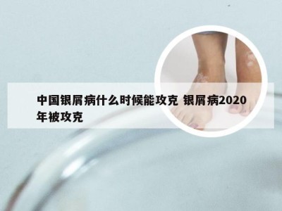 中国银屑病什么时候能攻克 银屑病2020年被攻克