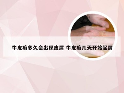 牛皮癣多久会出现皮屑 牛皮癣几天开始起屑
