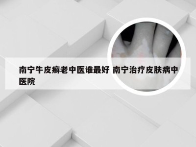 南宁牛皮癣老中医谁最好 南宁治疗皮肤病中医院