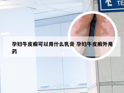 孕妇牛皮癣可以用什么乳膏 孕妇牛皮癣外用药
