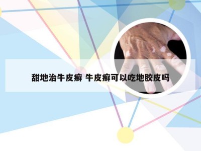 甜地治牛皮癣 牛皮癣可以吃地胶皮吗