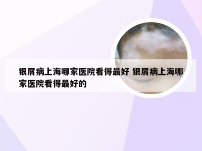 银屑病上海哪家医院看得最好 银屑病上海哪家医院看得最好的