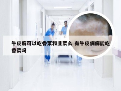 牛皮癣可以吃香菜和韭菜么 有牛皮病癣能吃香菜吗