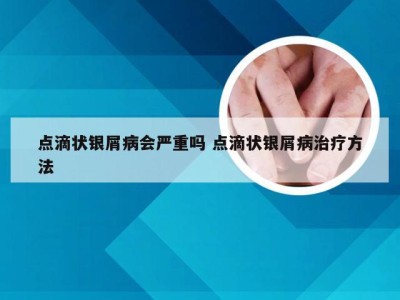 点滴状银屑病会严重吗 点滴状银屑病治疗方法