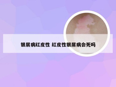 银屑病红皮性 红皮性银屑病会死吗