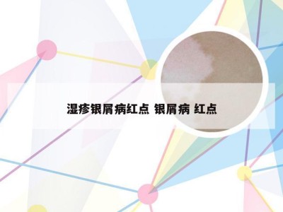 湿疹银屑病红点 银屑病 红点