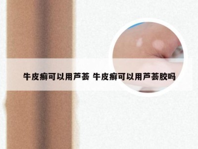 牛皮癣可以用芦荟 牛皮癣可以用芦荟胶吗