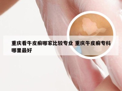 重庆看牛皮癣哪家比较专业 重庆牛皮癣专科哪里最好