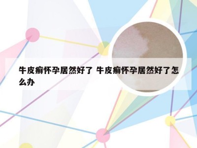 牛皮癣怀孕居然好了 牛皮癣怀孕居然好了怎么办