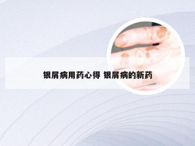 银屑病用药心得 银屑病的新药
