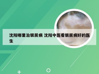 沈阳哪里治银屑病 沈阳中医看银屑病好的医生