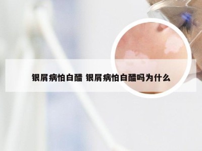 银屑病怕白醋 银屑病怕白醋吗为什么