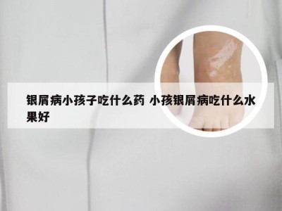 银屑病小孩子吃什么药 小孩银屑病吃什么水果好