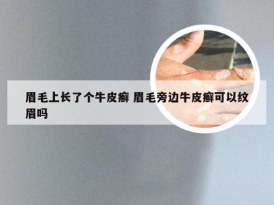 眉毛上长了个牛皮癣 眉毛旁边牛皮癣可以纹眉吗