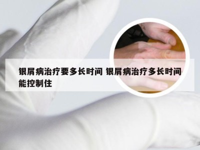 银屑病治疗要多长时间 银屑病治疗多长时间能控制住
