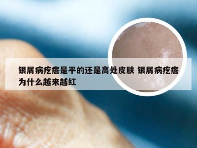 银屑病疙瘩是平的还是高处皮肤 银屑病疙瘩为什么越来越红