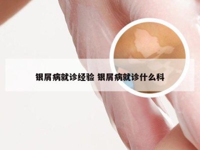 银屑病就诊经验 银屑病就诊什么科