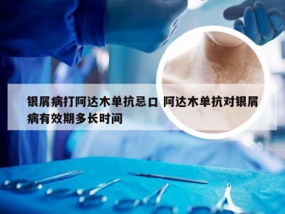 银屑病打阿达木单抗忌口 阿达木单抗对银屑病有效期多长时间