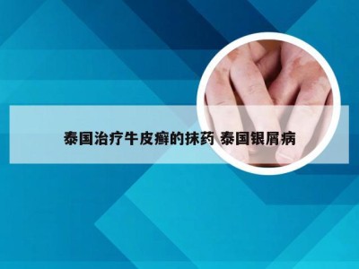 泰国治疗牛皮癣的抹药 泰国银屑病