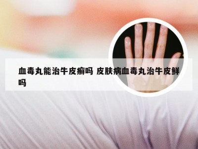 血毒丸能治牛皮癣吗 皮肤病血毒丸治牛皮鲜吗