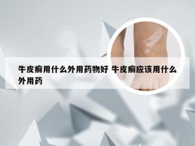 牛皮癣用什么外用药物好 牛皮癣应该用什么外用药