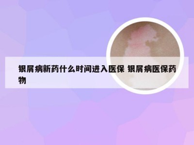 银屑病新药什么时间进入医保 银屑病医保药物