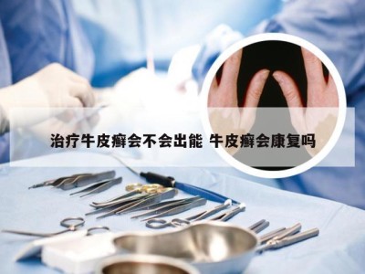 治疗牛皮癣会不会出能 牛皮癣会康复吗