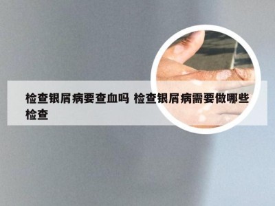 检查银屑病要查血吗 检查银屑病需要做哪些检查
