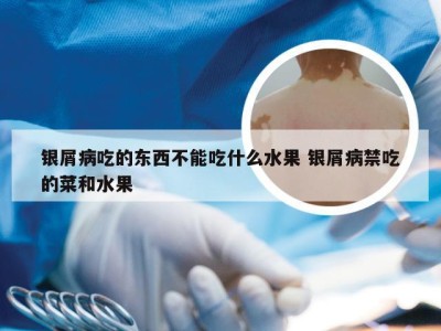 银屑病吃的东西不能吃什么水果 银屑病禁吃的菜和水果