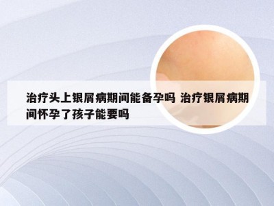 治疗头上银屑病期间能备孕吗 治疗银屑病期间怀孕了孩子能要吗