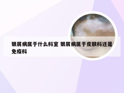 银屑病属于什么科室 银屑病属于皮肤科还是免疫科