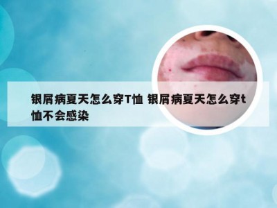 银屑病夏天怎么穿T恤 银屑病夏天怎么穿t恤不会感染
