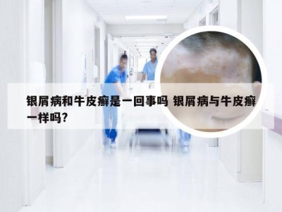 银屑病和牛皮癣是一回事吗 银屑病与牛皮癣一样吗?