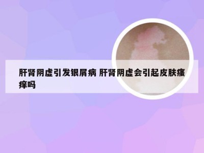 肝肾阴虚引发银屑病 肝肾阴虚会引起皮肤瘙痒吗