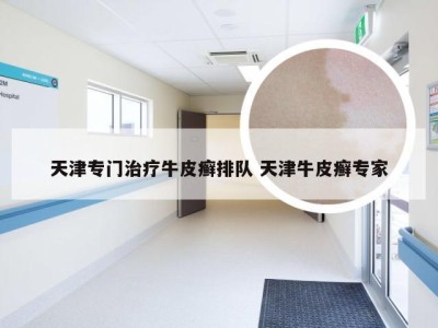 天津专门治疗牛皮癣排队 天津牛皮癣专家