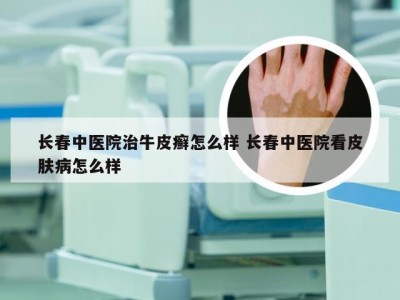 长春中医院治牛皮癣怎么样 长春中医院看皮肤病怎么样